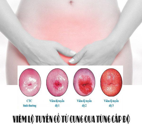 Viêm lộ tuyến cổ tử cung là gì? Mức độ nguy hiểm của bệnh